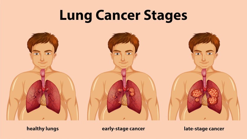 Lung Cancer Stages