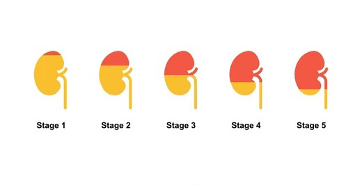 kidney-disease-stages