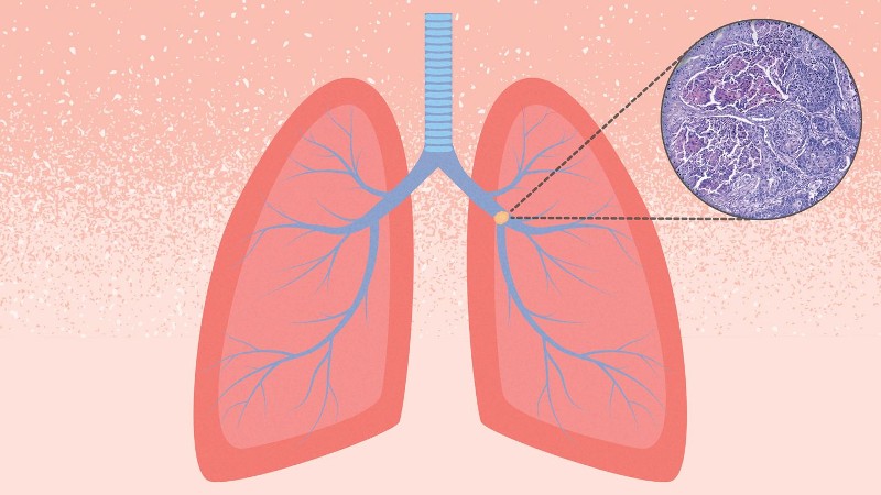 Lung Cancer Guide: Symptoms-Stages-Treatment-Survival Rates